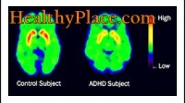 ADD和ADHD这两个术语是可以互换使用的。然而，根据DSM IV，更新的术语是ADHD(注意缺陷多动障碍)。