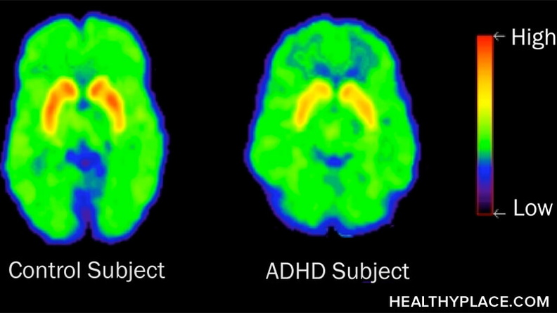 注意力缺陷多动障碍(ADHD)和注意力缺陷多动障碍(ADD)不是用来描述人或行为的形容词。ADD和ADHD是和其他疾病一样值得我们尊重的疾病。